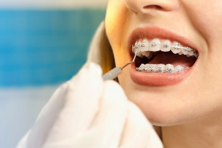سفید کردن دندان ارتودنسی شده
