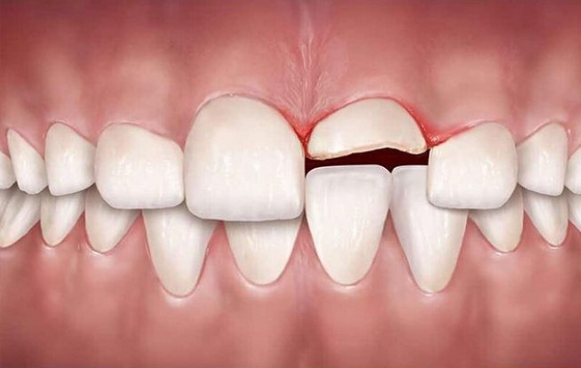 کجی و نامرتبی دندانها چه عوارض و مشکلاتی ایجاد می کند؟