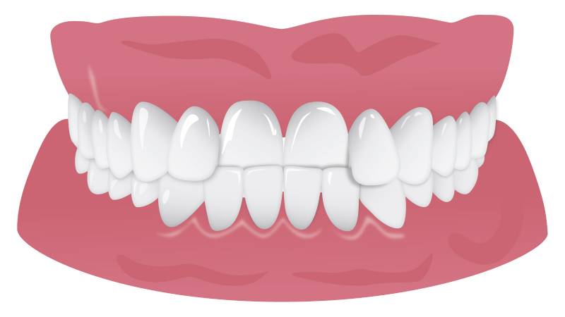 چه عواملی منجر به کجی و نامرتبی دندانها می شوند؟