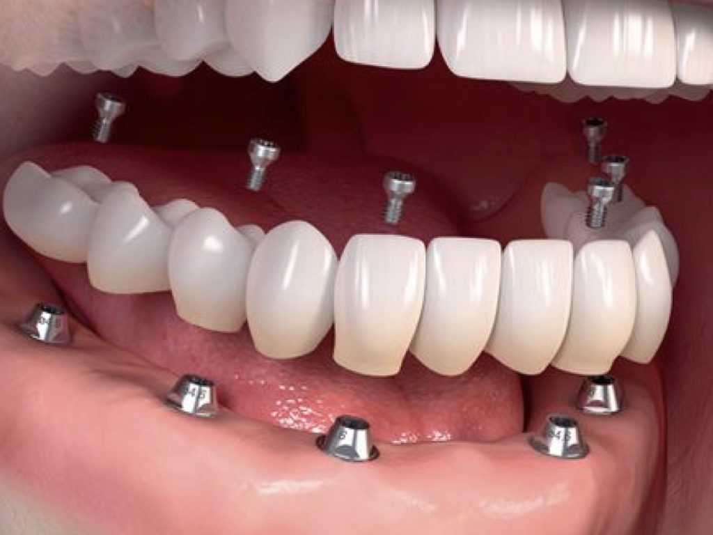 فرآیند عمل جراحی ایمپلنت دندان