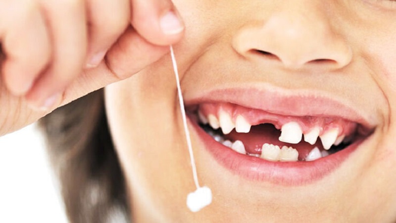 ایمپلنت دندان برای بزرگسالان و نوجوانان در چه شرایطی مناسب می باشد؟