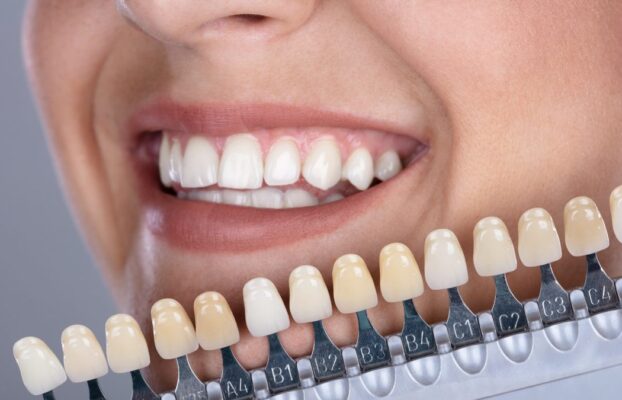 لمینت چیست؟ طول عمر و  روش نگهداری از لمینت دندان