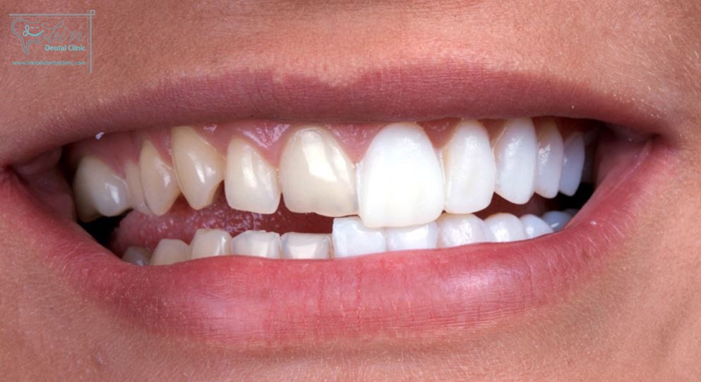تفاوت لمینت دندان و روکش دندان
