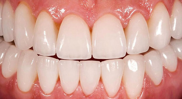 ونیر کامپوزیت دندان چیست؟