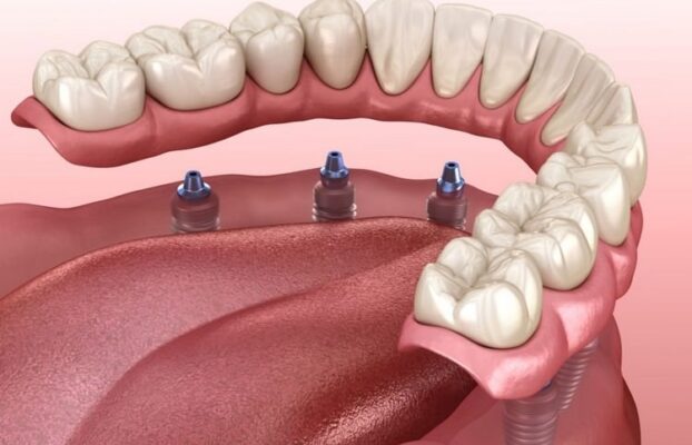  آیا می توان دندان مصنوعی متحرک را با ایمپلنت دندان جایگزین کرد؟