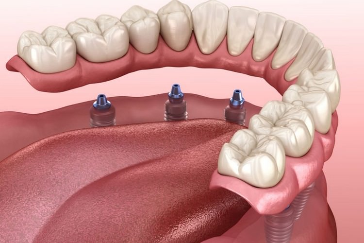  آیا می توان دندان مصنوعی متحرک را با ایمپلنت دندان جایگزین کرد؟
