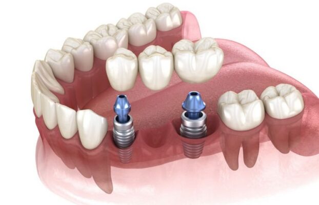 نقش اباتمنت در ایمپلنت دندانی