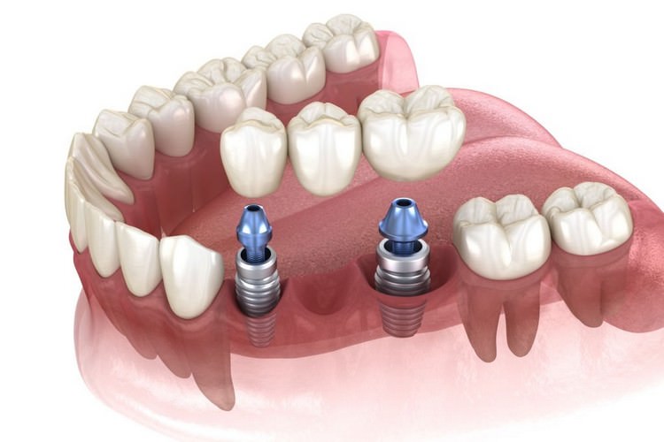 نقش اباتمنت در ایمپلنت دندانی