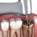 زمان ساخت پروتز دندان