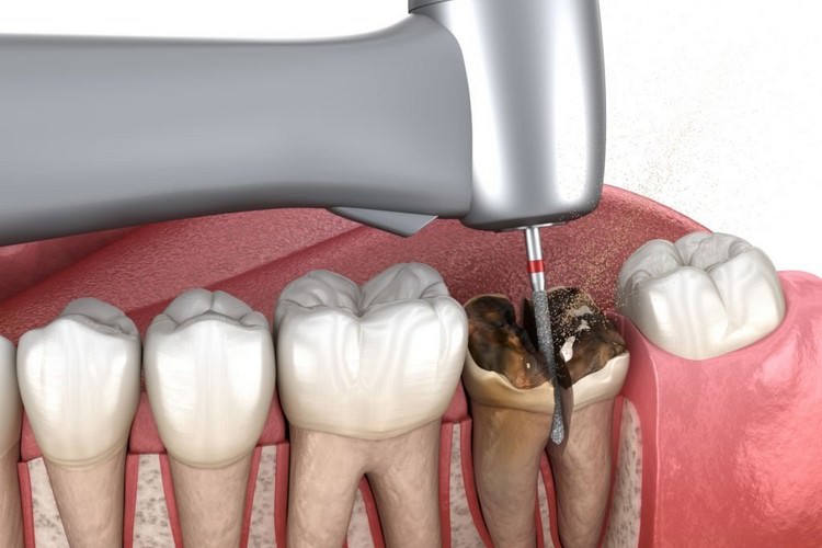 چند روز طول میکشد دندان مصنوعی ساخته شود؟