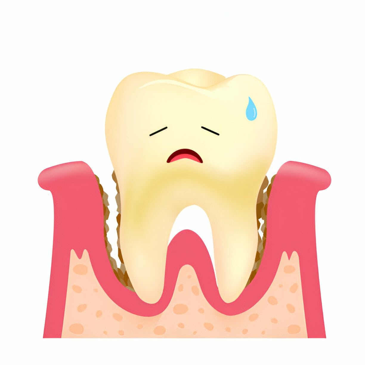 خرابی دندان بر اثر رفلاکس معده