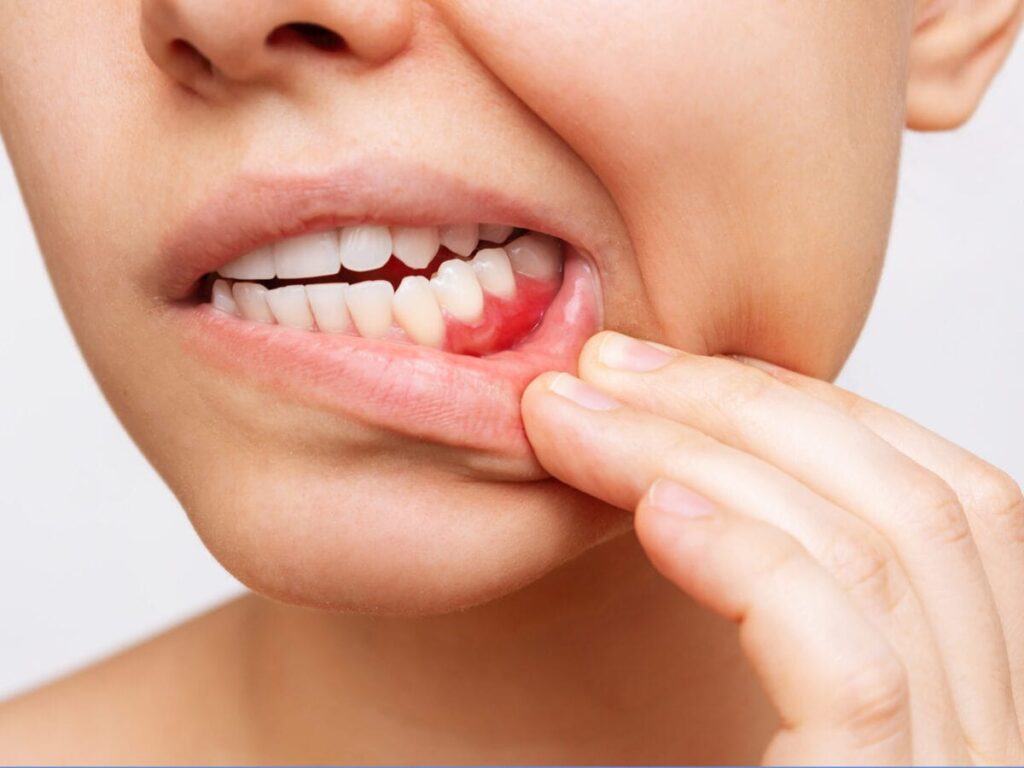 درمان کیست دهان در خانه