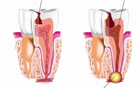 راه های درمان کیست های دندانی