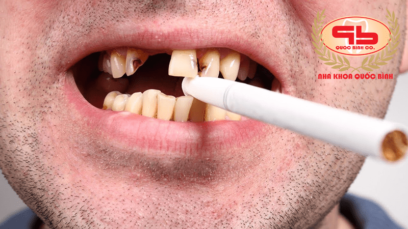 اثرات سیگار بر ایمپلنت دندان