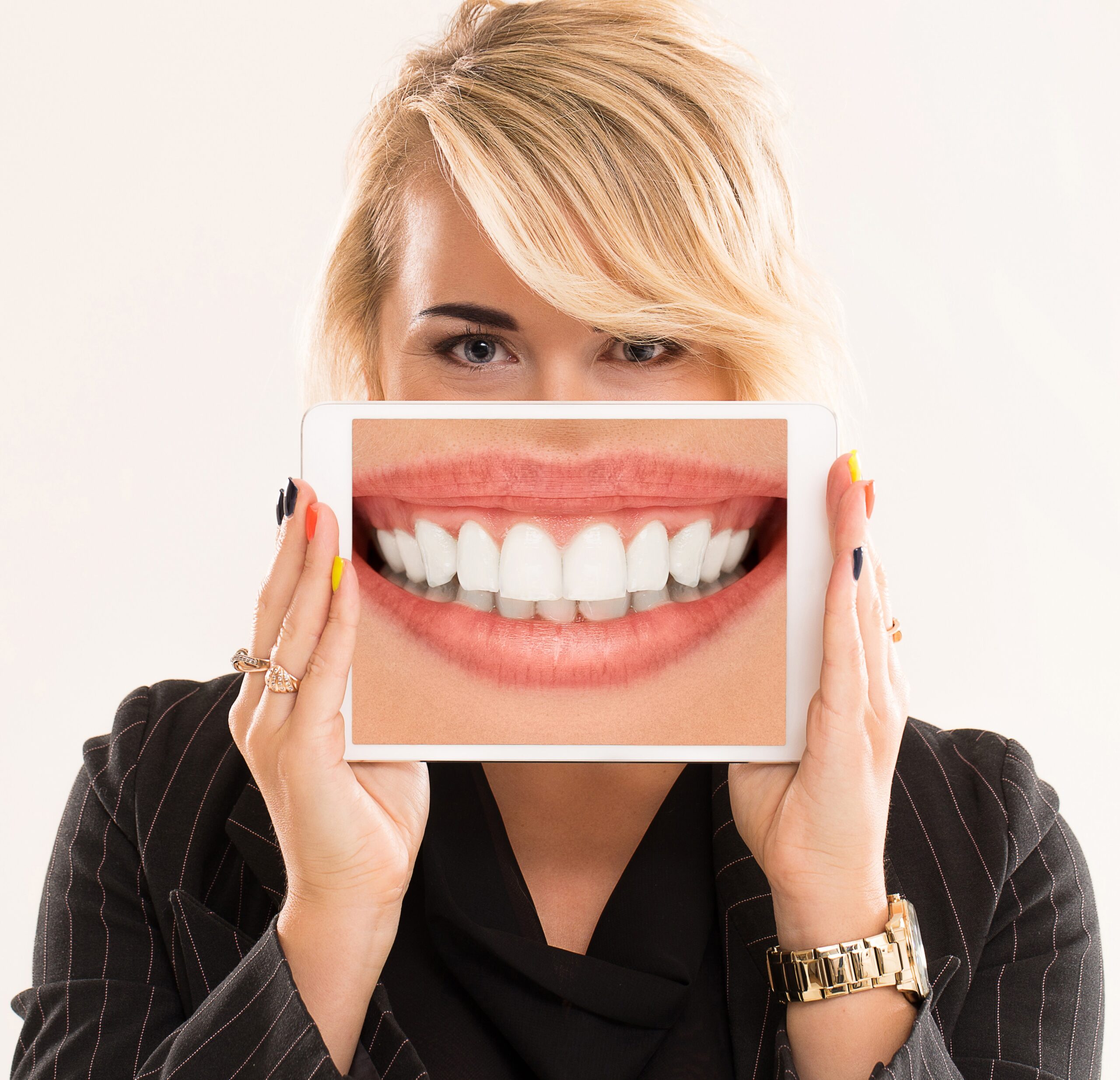 تعریف درمان بلیچینگ یا سفید کردن دندان_ مزایا و خطرات بلیچینگ