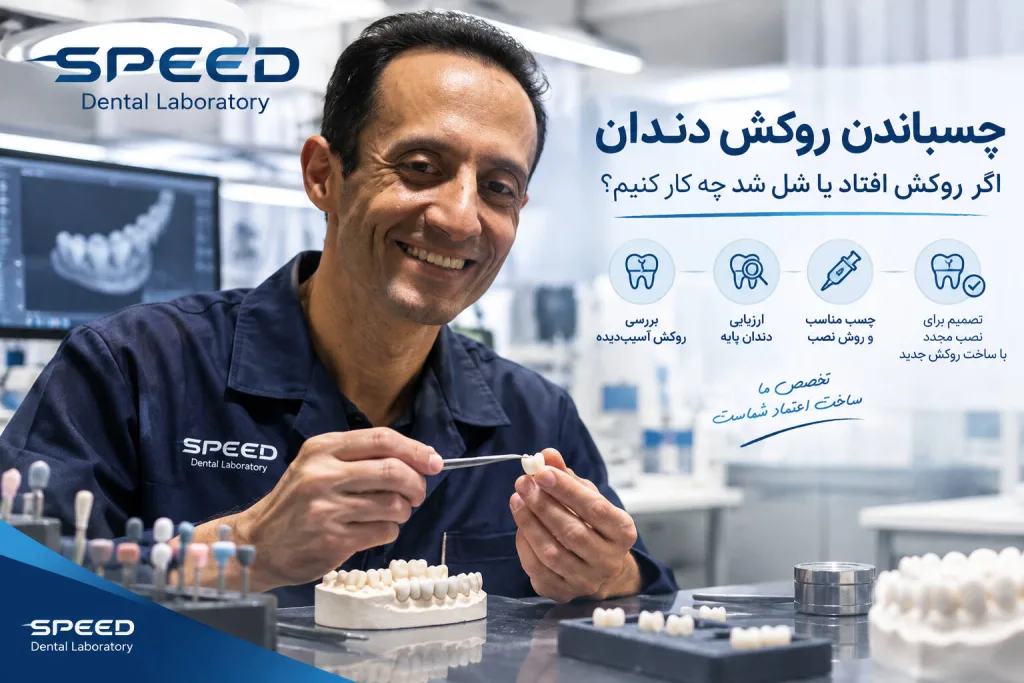 چسباندن روکش دندان؛ اگر روکش افتاد یا شل شد چه کار کنیم؟