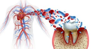 ژتژیویت چیست و چه تفاوتی با پری ایمپلنتیت دارد
