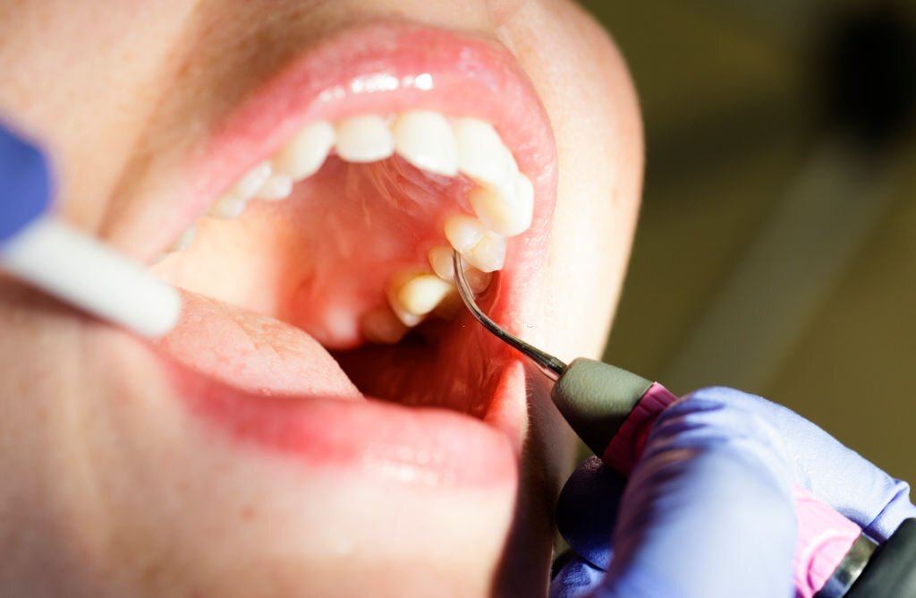 بهترین روش برای تعمیر دندان مصنوعی لق