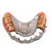 آیا کشیدن دندان بیماری پریودنتال را درمان می کند؟