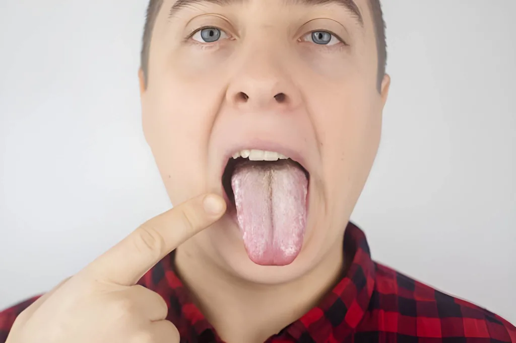 عفونت کاندیدا آلبیکانس در دهان